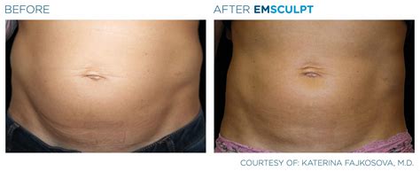 EMSculpt Toronto | Nonsurgical Butt Lift & Muscle Toning | EMSculpt Near Me | EMSculpt Cost