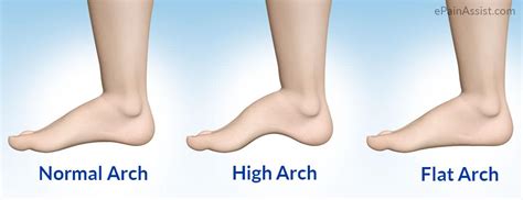 High Arch Foot -- Overview & Characteristics | EVA Orthotic Insoles Manufacturer | Ideastep