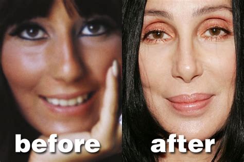 Cher plastic surgery Before and After Botox and Nose Jobs (Star plastic surgery)