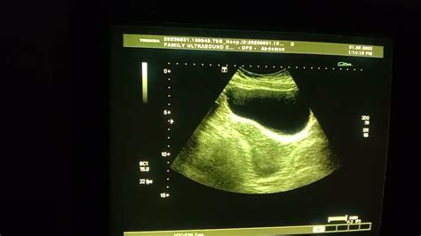 #subserosal fibroid on posterior wall of the uterus #ultrasound # ...