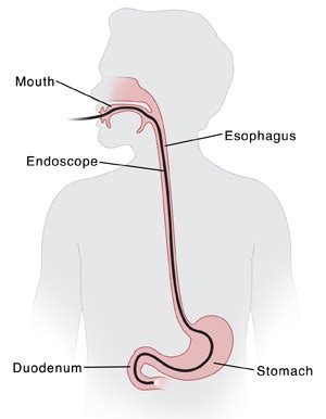 Upper GI Endoscopy with Biopsy | Saint Luke's Health System