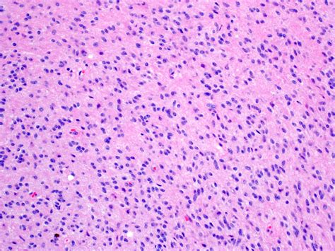 Pathology Outlines - Pilocytic astrocytoma