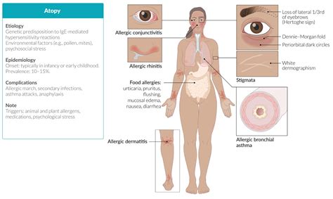 Hypersensitivity Type I & Atopic Diseases | FOS Media Students' Blog