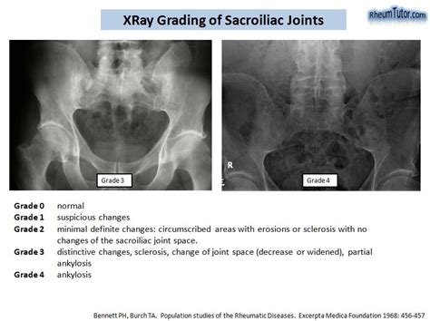 Ankylosing Spondylitis Mri Si Joint