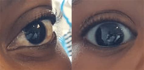 Right eye sclera of the child (right) compared with the left eye sclera ...