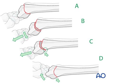 Closed reduction - K-wires and cast/external fixator for Extraarticular fracture of the radius ...