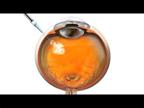 What is Avastin Eye Injection - Eye Health Nepal