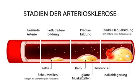 Wie verläuft eine Arteriosklerose?