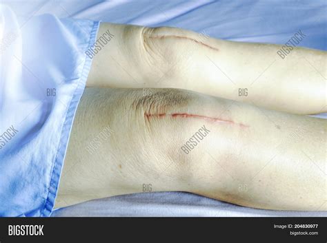 Scars Surgical Knee Image & Photo (Free Trial) | Bigstock