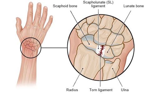 Wrist injuries | informedhealth.org