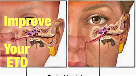 How I unclogged my ears and improved my Eustachian Tube Dysfunction - YouTube