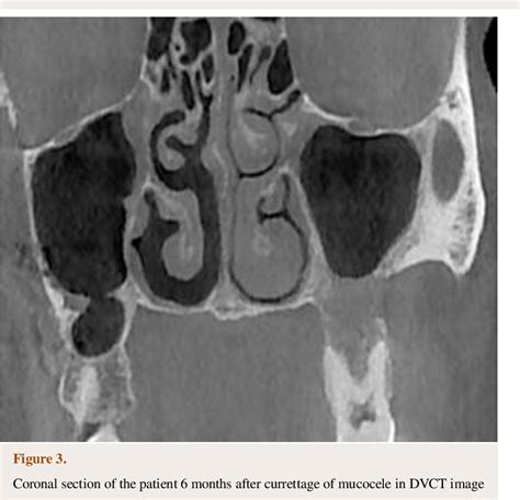 Figure 3 from Maxillary Sinus Mucocele As an Unusual Complication of Orthognathic Surgery: Case ...