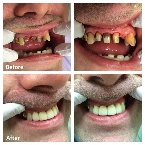 How Do Dentists Remove An Old Crown at Margaret Bown blog