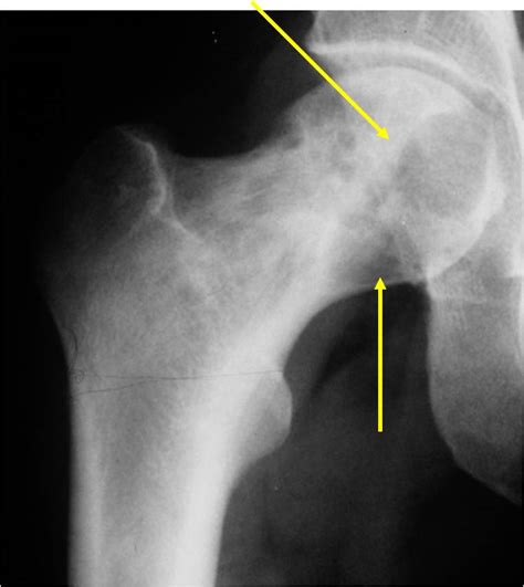 Bone Cancer: Bone Cancer Chondrosarcoma