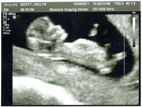 Our Scott Spot: 11 Week Ultrasound