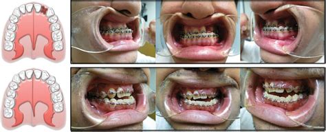 Maxillary Hypoplasia in the Cleft Patient: Contribution of O... : Plastic and Reconstructive Surgery