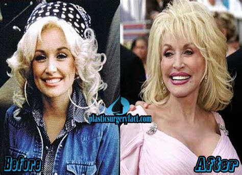 Top 10 Pictures of Celebrity Plastic Surgery Gone Wrong