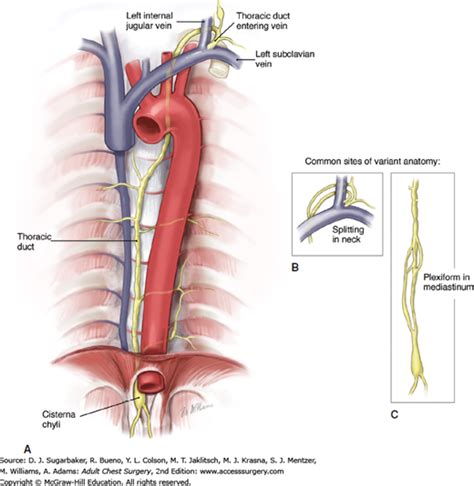 Surgical Management of Chylothorax | Adult Chest Surgery, 2e | AccessSurgery | McGraw-Hill Medical