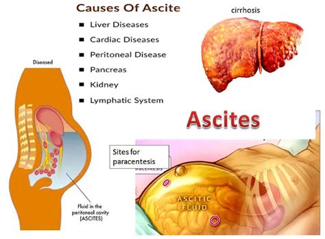 Ascites cause, grades, symptoms, diagnosis and Treatment of cirrhotic ascites | Science online