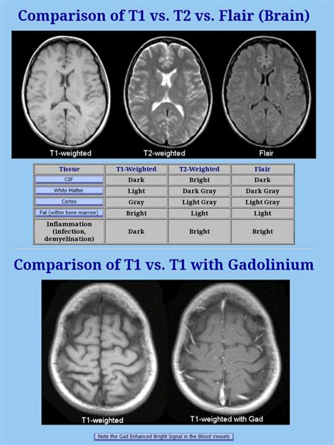 What Is T1 And T2 MRI