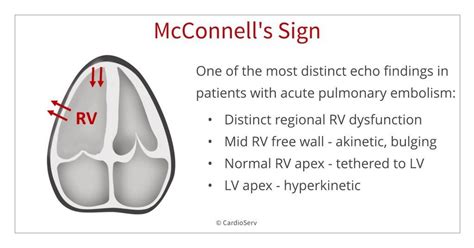 Do Lets Get Back To Traders What Is: Mcconnell Sign Pulmonary Embolism Echo