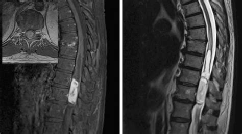 Intramedullary Spinal Cord Tumor | The Neurosurgical Atlas