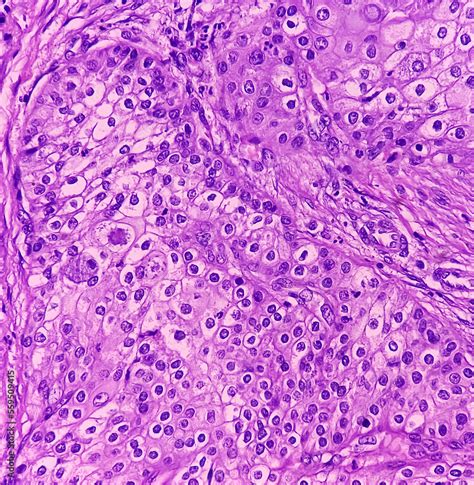 High grade mucoepidermoid carcinoma of parotid cyst. Microscopic show parotid tissue, features ...