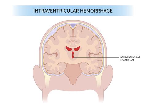 Intraventricular Hemorrhage | Advocate Health Care