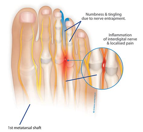 Metatarsalgia – ICB Medical