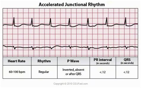 This ECG Interpretation course will show how to identify normal versus abnormal cardiac anatomy ...