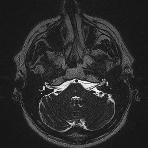 Vestibular Nerve Mri