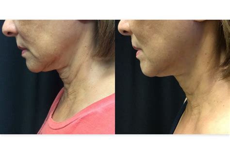 Microneedling - Before & After Pictures of Neck, Wrinkles and More