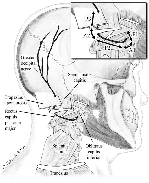 Diagram of the greater occipital nerve | Image | Radiopaedia.org