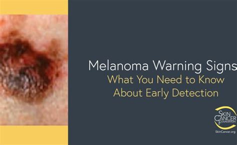 Melanoma Skin Cancer Symptoms And Signs – Boredmonday