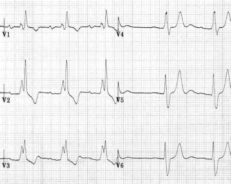 T wave • LITFL • ECG Library Basics