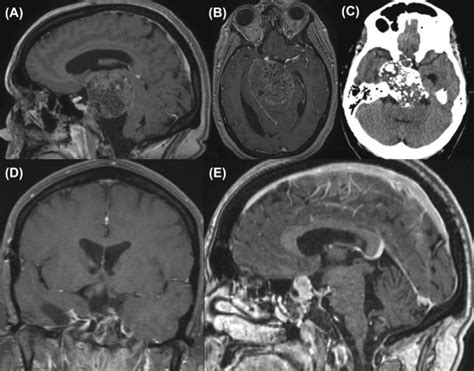 Staged Approaches for Large Skull Base Chordomas and Chondrosarcomas ...