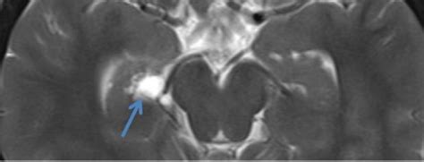 Choroidal fissure cyst | Download Scientific Diagram