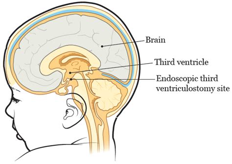 Postoperatorio ventriculostomía