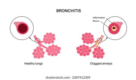 Bronchitis Concept Infection Lungs Bronchi Anatomical Stock Vector ...