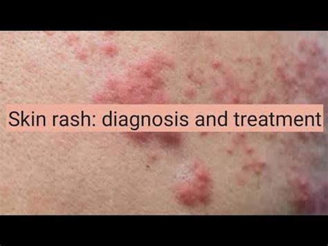 Skin Rash - Types, Treatment | Diseases 2023