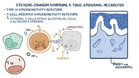 Stevens-Johnson syndrome: Video, Anatomy & Definition | Osmosis