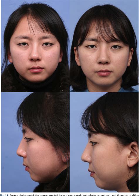 Figure 18 from Rhinoplasty in the Asian nose. | Semantic Scholar