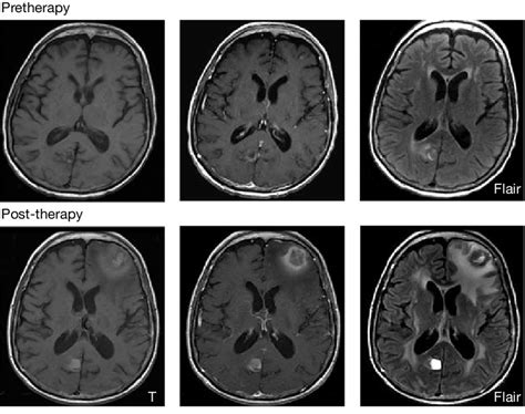 Radiographic changes to melanoma metastases in the brain with... | Download Scientific Diagram