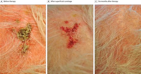 Aminolevulinic Acid Photodynamic Therapy in the Treatment of Erosive ...