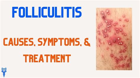 FOLLICULITIS Causes, Symptoms, & Treatments - YouTube