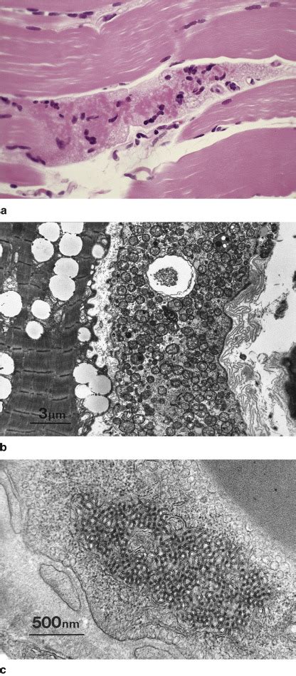 Toxic and Drug-Induced Myopathies | Musculoskeletal Key