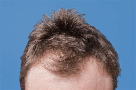 6 Common Hair Loss Causes in Men | Man of Many