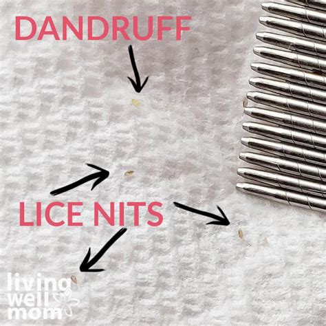 How to Get Rid of Lice Without Chemicals (Natural Lice Treatment) – Retail Planning Blog