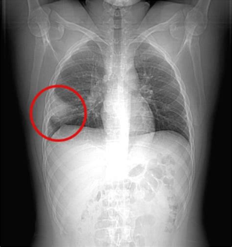 Tromboembolismo Pulmonar em um Paciente Jovem com COVID-19 - ABC Cardiol