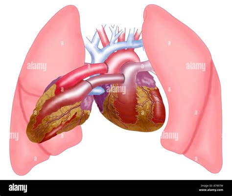 Piggy back heart transplant hi-res stock photography and images - Alamy